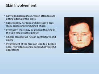 Skin Involvement
• Early edematous phase, which often feature
pitting edema of the digits
• Subsequently hardens and develops a taut,
shiny appearance (indurated phase)
• Eventually, there may be gradual thinning of
the skin (late atrophic phase)
• Fingers can develop flexion contractures and
ulcers
• Involvement of the face can lead to a beaked
nose, microstomia and a somewhat youthful
appearance
 
