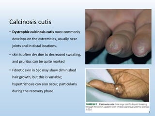 • Dystrophic calcinosis cutis most commonly
develops on the extremities, usually near
joints and in distal locations.
• skin is often dry due to decreased sweating,
and pruritus can be quite marked
• Fibrotic skin in SSc may show diminished
hair growth, but this is variable;
hypertrichosis can also occur, particularly
during the recovery phase
Calcinosis cutis
 
