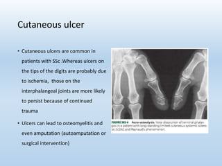 Cutaneous ulcer
• Cutaneous ulcers are common in
patients with SSc .Whereas ulcers on
the tips of the digits are probably due
to ischemia, those on the
interphalangeal joints are more likely
to persist because of continued
trauma
• Ulcers can lead to osteomyelitis and
even amputation (autoamputation or
surgical intervention)
 