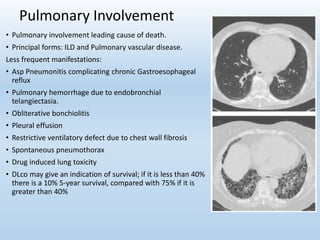 Pulmonary Involvement
• Pulmonary involvement leading cause of death.
• Principal forms: ILD and Pulmonary vascular disease.
Less frequent manifestations:
• Asp Pneumonitis complicating chronic Gastroesophageal
reflux
• Pulmonary hemorrhage due to endobronchial
telangiectasia.
• Obliterative bonchiolitis
• Pleural effusion
• Restrictive ventilatory defect due to chest wall fibrosis
• Spontaneous pneumothorax
• Drug induced lung toxicity
• DLco may give an indication of survival; if it is less than 40%
there is a 10% 5-year survival, compared with 75% if it is
greater than 40%
 
