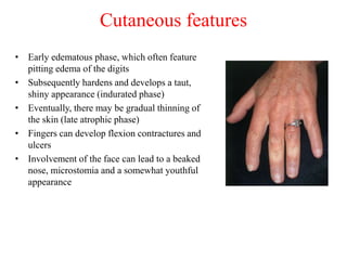Cutaneous features
• Early edematous phase, which often feature
pitting edema of the digits
• Subsequently hardens and develops a taut,
shiny appearance (indurated phase)
• Eventually, there may be gradual thinning of
the skin (late atrophic phase)
• Fingers can develop flexion contractures and
ulcers
• Involvement of the face can lead to a beaked
nose, microstomia and a somewhat youthful
appearance
 