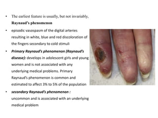 • The earliest feature is usually, but not invariably,
Raynaud’s phenomenon
• episodic vasospasm of the digital arteries
resulting in white, blue and red discoloration of
the fingers secondary to cold stimuli
• Primary Raynaud’s phenomenon (Raynaud’s
disease): develops in adolescent girls and young
women and is not associated with any
underlying medical problems. Primary
Raynaud’s phenomenon is common and
estimated to affect 3% to 5% of the population
• secondary Raynaud’s phenomenon :
uncommon and is associated with an underlying
medical problem
 