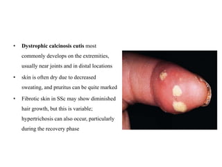 • Dystrophic calcinosis cutis most
commonly develops on the extremities,
usually near joints and in distal locations
• skin is often dry due to decreased
sweating, and pruritus can be quite marked
• Fibrotic skin in SSc may show diminished
hair growth, but this is variable;
hypertrichosis can also occur, particularly
during the recovery phase
 