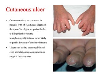 Cutaneous ulcer
• Cutaneous ulcers are common in
patients with SSc .Whereas ulcers on
the tips of the digits are probably due
to ischemia those on the
interphalangeal joints are more likely
to persist because of continued trauma
• Ulcers can lead to osteomyelitis and
even amputation (autoamputation or
surgical intervention)
 