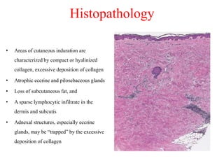 Histopathology
• Areas of cutaneous induration are
characterized by compact or hyalinized
collagen, excessive deposition of collagen
• Atrophic eccrine and pilosebaceous glands
• Loss of subcutaneous fat, and
• A sparse lymphocytic infiltrate in the
dermis and subcutis
• Adnexal structures, especially eccrine
glands, may be “trapped” by the excessive
deposition of collagen
 