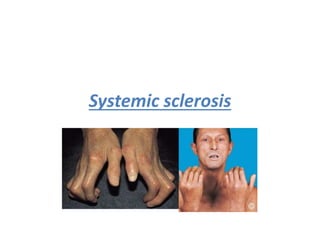 Systemic sclerosis
h
 
