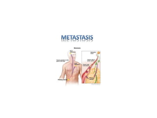 Metastatic Disease
 