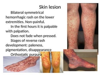 Systemic Vasculitis IgA vasculitis .pptx