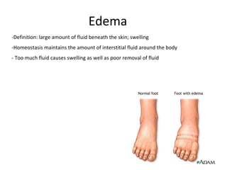 Edema
-Definition: large amount of fluid beneath the skin; swelling
-Homeostasis maintains the amount of interstitial fluid around the body
- Too much fluid causes swelling as well as poor removal of fluid
 