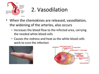 2. Vasodilation
• When the chemokines are released, vasodilation,
the widening of the arteries, also occurs
– Increases the blood flow to the infected area, carrying
the needed white blood cells
– Causes the redness and heat as the white blood cells
work to cure the infection
 