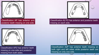 Comprehensive Overview of Partially Dentulous Arch Classification ...