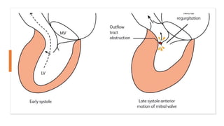 Mitral Valve Systolic Anterior – DYNF