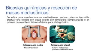 Biopsias quirúrgicas y resección de
masas mediastínicas.
Se indica para aquellos tumores mediastínicos en los cuales es imposible
efectuar una biopsia con aguja guiada con tomografía computarizada o en
quienes no se obtiene tejido suficiente para el diagnóstico.

Estereotomía media

Toracotomía lateral

• Mediastino anterior

• Tumores mediastínicos
grandes con extensión lateral

 