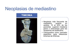 Neoplasias de mediastino
TIMOMA
• Neoplasia más frecuente de
mediastino
anterior
en
adultos. 10 al 50% de los
pacientes sugieren miastenia
grave o anticuerpos para los
receptores de acetilcolina.
• Citoqueratina como marcador
especifico para diferenciar
timomas de linfomas.

 