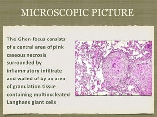 MICROSCOPIC PICTURE
The Ghon focus consists
of a central area of pink
caseous necrosis
surrounded by
inflammatory infiltrate
and walled of by an area
of granulation tissue
containing multinucleated
Langhans giant cells
 