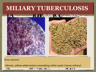 G
Gr
ro
oss
ss p
piic
ct
tu
ur
re
e:
:
MinMinuuttee,,y
e
e
l
l
l
l
o
o
w
-
w
w
-
w
h
h
i
i
t
t
e
e
lleesisioonnss rreseesembmblliningg
mill
mille
et
t see
seeds
ds (
(
h
h
e
e
n
n
c
c
e
e
milmiliaiarry))
Gross picture:
Minute, yellow-white lesions resembling millet seeds ( hence miliary)
MI
MIL
L
IA
Y
T
U
B
E
T
U
B
E
R
R
C
LOSI
O
SIS
S
MILIARY TUBERCULOSIS
 
