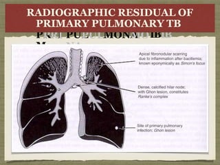 R
RA
ADI
DI
O
PR
PRI
I
M
GRA
RAPHI
PHIC
C R
R
E
E
S
S
I
I
DARY
RY
PUL
PULMONA
MO
NA
D
U
A
U
A
L
LO
O
F
FRY
Y
TBTB
RADIOGRAPHIC RESIDUAL OF
PRIMARY PULMONARY TB
 