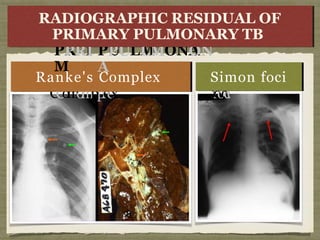 x
R annkkee'ss
C
C
o
m
o
m
p
l
p
l
e
e
x
SimSimonon
f
f
o
o
c
i
c
i
Ranke's Complex Simon foci
RA
RADI
DIO
PR
PRI
I
M
GR
RA
AP
PHI
HIC
C R
R
E
S
I
E
S
I
DAR
RY
Y
PU
PULM
LMONA
ON
A
U
A
A
L
L
O
F
O
F
R
RY
Y TBTB
RADIOGRAPHIC RESIDUAL OF
PRIMARY PULMONARY TB
 