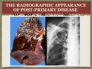 THETHE
R
A
R
A
D
I
D
I
OF
OF PO
O
OG
GRA
RAPHI
PHIC
CA
A
P
T-
-
PR
PRI
IMA
MAR
RY
Y
D
DI
I
EARA
RAN
NCE
CE
SEA
SEAS
SE
E
THE RADIOGRAPHIC APPEARANCE
OF POST-PRIMARY DISEASE
 