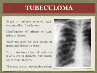 T B
E
C
C
U
U
L
L
O A
TUBECULOMA
well-
post-
Single or multiple rounded,
circumscribed, focal lesions
Manifestation of primary or
primary disease
Easily mistaken for coin lesions or
metastatic disease on chest
Vary in size from a few millimeters to
5 or 6 cm in diameter but usually
range from 1 to 3 cm.
They may or may not contain calcium
 