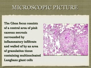 MICROSCOPIC PICTUREMICROSCOPIC PICTURE
The Ghon focus consistsThe Ghon focus consists
of a central area of pinkof a central area of pink
caseous necrosiscaseous necrosis
surrounded bysurrounded by
inflammatory infiltrateinflammatory infiltrate
and walled of by an areaand walled of by an area
of granulation tissueof granulation tissue
containing multinucleatedcontaining multinucleated
Langhans giant cellsLanghans giant cells
 