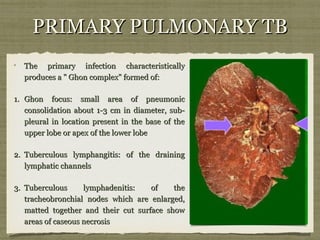 PRIMARY PULMONARY TBPRIMARY PULMONARY TB
The primary infection characteristicallyThe primary infection characteristically
produces a " Ghon complex" formed of:produces a " Ghon complex" formed of:
1.1. Ghon focus: small area of pneumonicGhon focus: small area of pneumonic
consolidation about 1-3 cm in diameter, sub-consolidation about 1-3 cm in diameter, sub-
pleural in location present in the base of thepleural in location present in the base of the
upper lobe or apex of the lower lobeupper lobe or apex of the lower lobe
2.2. Tuberculous lymphangitis: of the drainingTuberculous lymphangitis: of the draining
lymphatic channelslymphatic channels
3.3. Tuberculous lymphadenitis: of theTuberculous lymphadenitis: of the
tracheobronchial nodes which are enlarged,tracheobronchial nodes which are enlarged,
matted together and their cut surface showmatted together and their cut surface show
areas of caseous necrosisareas of caseous necrosis
 