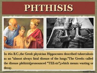 PHTHISISPHTHISISPHTHISISPHTHISIS
In 46o B.C.,the Greek physician Hippocrates described tuberculosisIn 46o B.C.,the Greek physician Hippocrates described tuberculosis
as an "almost always fatal disease of the lungs."The Greeks calledas an "almost always fatal disease of the lungs."The Greeks called
the disease phthisis(pronounced "TEE-sis"),which means wasting orthe disease phthisis(pronounced "TEE-sis"),which means wasting or
decay.decay.
In 46o B.C.,the Greek physician Hippocrates described tuberculosisIn 46o B.C.,the Greek physician Hippocrates described tuberculosis
as an "almost always fatal disease of the lungs."The Greeks calledas an "almost always fatal disease of the lungs."The Greeks called
the disease phthisis(pronounced "TEE-sis"),which means wasting orthe disease phthisis(pronounced "TEE-sis"),which means wasting or
decay.decay.
Hamdi TurkeyHamdi Turkey
 