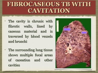FIBROCASEOUS TB WITHFIBROCASEOUS TB WITH
CAVITATIONCAVITATION
FIBROCASEOUS TB WITHFIBROCASEOUS TB WITH
CAVITATIONCAVITATION
The cavity is chronic withThe cavity is chronic with
fibrotic walls, lined byfibrotic walls, lined by
caseous material and iscaseous material and is
traversed by blood vesselstraversed by blood vessels
and bronchiand bronchi
The surrounding lung tissueThe surrounding lung tissue
shows multiple focal areasshows multiple focal areas
of caseation and otherof caseation and other
cavitiescavities
 