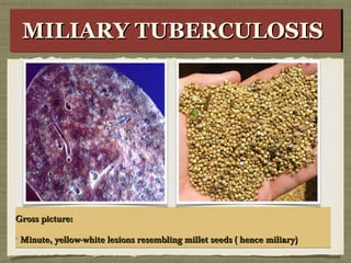 Gross picture:Gross picture:
Minute, yellow-white lesions resembling millet seeds ( hence miliary)Minute, yellow-white lesions resembling millet seeds ( hence miliary)
Gross picture:Gross picture:
Minute, yellow-white lesions resembling millet seeds ( hence miliary)Minute, yellow-white lesions resembling millet seeds ( hence miliary)
MILIARY TUBERCULOSISMILIARY TUBERCULOSISMILIARY TUBERCULOSISMILIARY TUBERCULOSIS
 