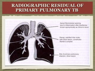RADIOGRAPHIC RESIDUAL OFRADIOGRAPHIC RESIDUAL OF
PRIMARY PULMONARY TBPRIMARY PULMONARY TB
RADIOGRAPHIC RESIDUAL OFRADIOGRAPHIC RESIDUAL OF
PRIMARY PULMONARY TBPRIMARY PULMONARY TB
 