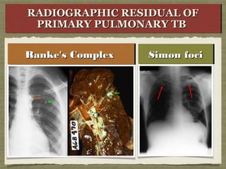 Ranke's ComplexRanke's ComplexRanke's ComplexRanke's Complex Simon fociSimon fociSimon fociSimon foci
RADIOGRAPHIC RESIDUAL OFRADIOGRAPHIC RESIDUAL OF
PRIMARY PULMONARY TBPRIMARY PULMONARY TB
RADIOGRAPHIC RESIDUAL OFRADIOGRAPHIC RESIDUAL OF
PRIMARY PULMONARY TBPRIMARY PULMONARY TB
 