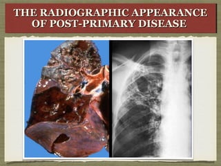 THE RADIOGRAPHIC APPEARANCETHE RADIOGRAPHIC APPEARANCE
OF POST-PRIMARY DISEASEOF POST-PRIMARY DISEASE
THE RADIOGRAPHIC APPEARANCETHE RADIOGRAPHIC APPEARANCE
OF POST-PRIMARY DISEASEOF POST-PRIMARY DISEASE
 