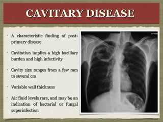 CAVITARY DISEASECAVITARY DISEASECAVITARY DISEASECAVITARY DISEASE
A characteristic finding of post-A characteristic finding of post-
primary diseaseprimary disease
Cavitation implies a high bacillaryCavitation implies a high bacillary
burden and high infectivityburden and high infectivity
Cavity size ranges from a few mmCavity size ranges from a few mm
to several cmto several cm
Variable wall thicknessVariable wall thickness
Air fluid levels rare, and may be anAir fluid levels rare, and may be an
indication of bacterial or fungalindication of bacterial or fungal
superinfectionsuperinfection
 