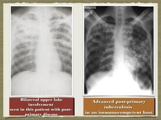 Bilateral upper lobeBilateral upper lobe
involvementinvolvement
seen in this patient with post-seen in this patient with post-
primary diseaseprimary disease
Bilateral upper lobeBilateral upper lobe
involvementinvolvement
seen in this patient with post-seen in this patient with post-
primary diseaseprimary disease
Advanced post-primaryAdvanced post-primary
tuberculosistuberculosis
in an immunocompetent hostin an immunocompetent host
Advanced post-primaryAdvanced post-primary
tuberculosistuberculosis
in an immunocompetent hostin an immunocompetent host
 
