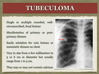 TUBECULOMATUBECULOMATUBECULOMATUBECULOMA
Single or multiple rounded, well-Single or multiple rounded, well-
circumscribed, focal lesionscircumscribed, focal lesions
Manifestation of primary or post-Manifestation of primary or post-
primary diseaseprimary disease
Easily mistaken for coin lesions orEasily mistaken for coin lesions or
metastatic disease on chestmetastatic disease on chest
Vary in size from a few millimeters toVary in size from a few millimeters to
5 or 6 cm in diameter but usually5 or 6 cm in diameter but usually
range from 1 to 3 cm.range from 1 to 3 cm.
They may or may not contain calciumThey may or may not contain calcium
 