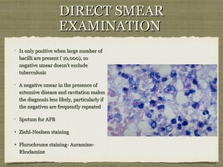 DIRECT SMEARDIRECT SMEAR
EXAMINATIONEXAMINATION
Is only positive when large number ofIs only positive when large number of
bacilli are present ( 10,000), sobacilli are present ( 10,000), so
negative smear doesn't excludenegative smear doesn't exclude
tuberculosistuberculosis
A negative smear in the presence ofA negative smear in the presence of
extensive disease and cavitation makesextensive disease and cavitation makes
the diagnosis less likely, particularly ifthe diagnosis less likely, particularly if
the negatives are frequently repeatedthe negatives are frequently repeated
Sputum for AFBSputum for AFB
• Ziehl-Neelsen stainingZiehl-Neelsen staining
• Flurochrome staining- Auramine-Flurochrome staining- Auramine-
RhodamineRhodamine
 