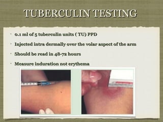 TUBERCULIN TESTINGTUBERCULIN TESTING
0.1 ml of 5 tuberculin units ( TU) PPD0.1 ml of 5 tuberculin units ( TU) PPD
Injected intra dermally over the volar aspect of the armInjected intra dermally over the volar aspect of the arm
Should be read in 48-72 hoursShould be read in 48-72 hours
Measure induration not erythemaMeasure induration not erythema
 