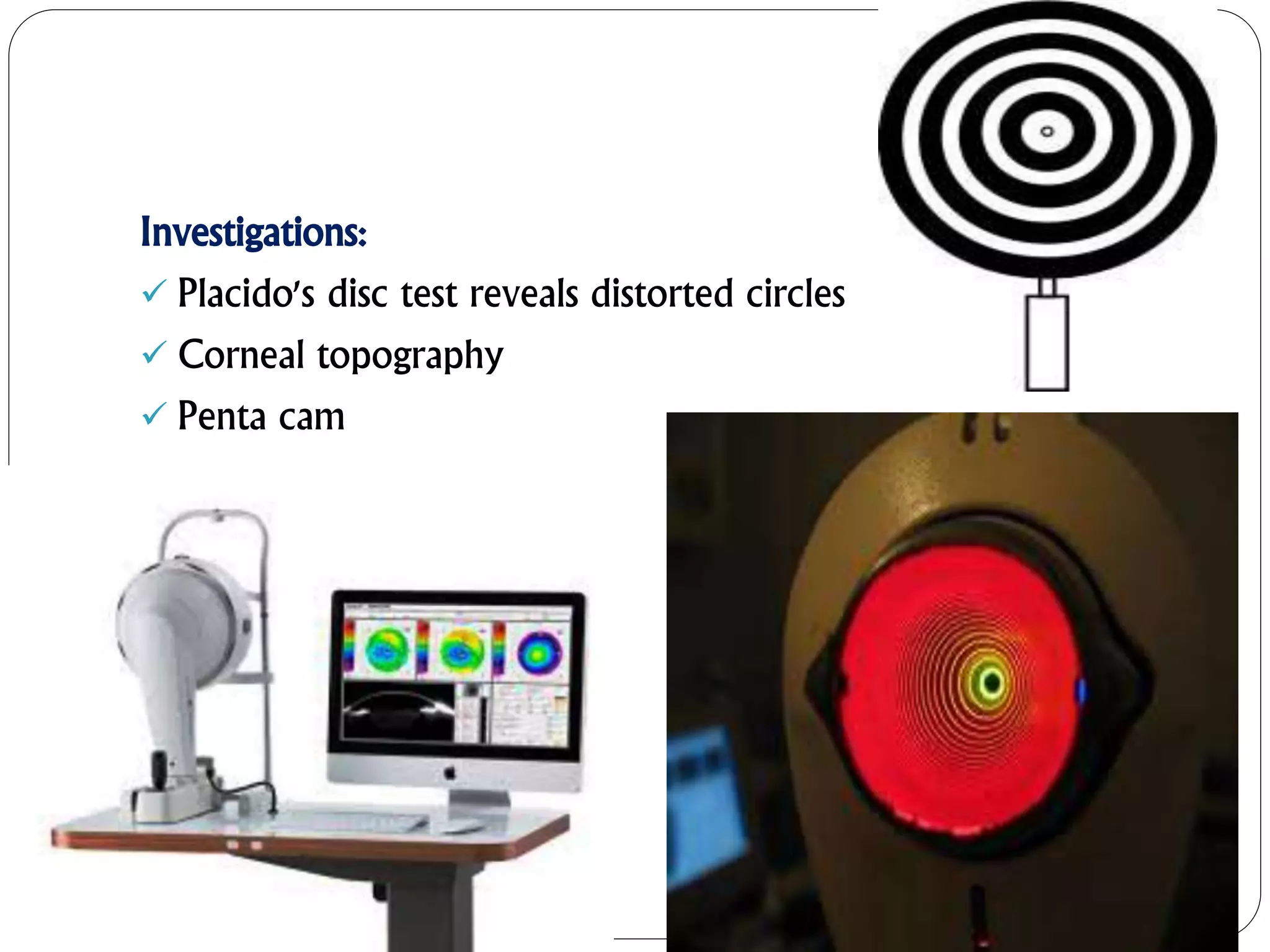 Investigations:
 Placido's disc test reveals distorted circles
 Corneal topography
 Penta cam
 