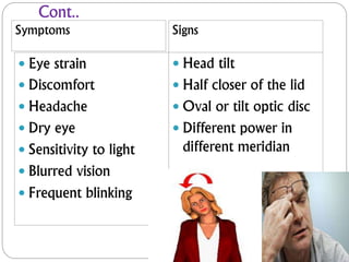 Cont..
 Eye strain
 Discomfort
 Headache
 Dry eye
 Sensitivity to light
 Blurred vision
 Frequent blinking
 Head tilt
 Half closer of the lid
 Oval or tilt optic disc
 Different power in
different meridian
Symptoms Signs
 
