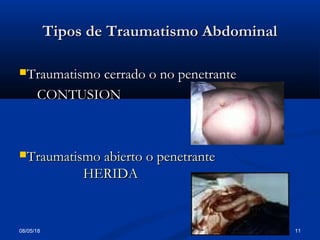 08/05/18 11
Tipos de Traumatismo AbdominalTipos de Traumatismo Abdominal
Traumatismo cerrado o no penetranteTraumatismo cerrado o no penetrante
CONTUSIONCONTUSION
Traumatismo abierto o penetranteTraumatismo abierto o penetrante
HERIDAHERIDA
 