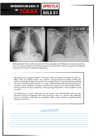 ANOTAÇÕES
Além dessas duas projeções, existem outras que devem ser citadas. A projeção em perfil, ou
lateral, deve ser pedida sempre que possível, porque ela auxilia a imagem em PA, para
melhor visualização de algumas estruturas. Um exemplo disso é o sinal da perda do gradiente
da coluna, que observamos quando um corpo vertebral inferior está mais denso do que os
primeiros corpos vertebrais, quando o normal seria o oposto. Se um corpo vertebral inferior
está mais branco do que os superiores, indica que algo está errado, e isso só poderá ser visto
no perfil.
Ao analisarmos um raio-X devemos ter uma ordem, uma sistematização para que não
percamos nenhum sinal alterado, além disso, temos que saber se o exame está adequado
para ser analisado, verificando sua qualidade. Desse modo, devemos programar nossa
mente para não errar.
Radiografias de tórax, sendo a primeira em PA e a segunda em AP. Observe as marcas vasculares,
que na primeira imagem são calibrosas apenas nos quadrantes inferiores, enquanto na segunda,
aparecem com todos os segmentos espessados
INTENSIVO DE RAIO-X
DE
aula 01
 