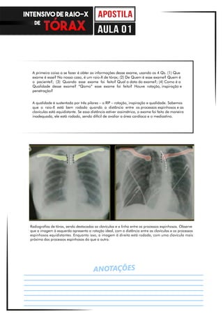 ANOTAÇÕES
A primeira coisa a se fazer é obter as informações desse exame, usando os 4 Qs. (1) Que
exame é esse? No nosso caso, é um raio-X de tórax; (2) De Quem é esse exame? Quem é
o paciente?; (3) Quando esse exame foi feito? Qual a data do exame?; (4) Como é a
Qualidade desse exame? “Qomo” esse exame foi feito? Houve rotação, inspiração e
penetração?
A qualidade é sustentada por três pilares – o RIP – rotação, inspiração e qualidade. Sabemos
que o raio-X está bem rodado quando a distância entre os processos espinhosos e as
clavículas está equidistante. Se essa distância estiver assimétrica, o exame foi feito de maneira
inadequada, ele está rodado, sendo difícil de avaliar a área cardíaca e o mediastino.
Radiografias de tórax, sendo destacadas as clavículas e a linha entre os processos espinhosos. Observe
que a imagem à esquerda apresenta a rotação ideal, com a distância entre as clavículas e os processos
espinhosos equidistantes. Enquanto isso, a imagem à direita está rodada, com uma clavícula mais
próxima dos processos espinhosos do que a outra.
INTENSIVO DE RAIO-X
DE
aula 01
 