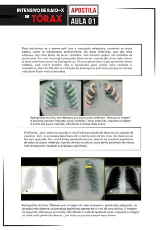 Radiografias de tórax, com destaque aos arcos costais anteriores. Note que a imagem
à esquerda está bem inspirada, sendo contados 7 arcos anteriores, enquanto a imagem
à direita está pouco inspirada, dificultando a análise desse exame
Finalmente, para sabermos quando o raio-X está bem penetrado devemos ser capazes de
visualizar bem os processos espinhosos até o nível do arco aórtico, mas, não devemos ver
tão bem após dele. Se o raio-X estiver penetrado demais, veremos os processos espinhosos
de todos os corpos vertebrais, focando demais na coluna. Já se estiver penetrado de menos,
mal conseguimos visualizar os processos espinhosos.
Radiografias de tórax. Observe que a imagem do meio apresenta a penetração adequada, ao
conseguirmos observar os processos espinhosos apenas até o nível do arco aórtico. A imagem
da esquerda, está pouco penetrada, dificultando a visão de qualquer coisa, enquanto a imagem
da direita está penetrada demais, com todos os processos espinhosos visíveis.
Para avaliarmos se o exame está com a inspiração adequada, contamos os arcos
costais, como já mencionado anteriormente. Os arcos anteriores, que são mais
oblíquos, são mais fáceis de serem contados, mas também podem ser contados os
posteriores. Em uma inspiração adequada devemos ser capazes de contar pelo menos
6 arcos anteriores acima do diafragma, ou 10 arcos posteriores. Caso apresente menos
costelas, esse raio-X também não é apropriado para avaliar área cardíaca e
mediastino, além de dificultar a avaliação do parênquima pulmonar, porque as marcas
vasculares ficam mais acentuadas
INTENSIVO DE RAIO-X
DE
aula 01
 