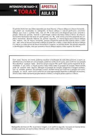 O pulmão direito tem seus lobos separados por duas fissuras: a fissura oblíqua e a fissura horizontal,
que podem ser visualizadas na radiografia. A fissura oblíqua é vista em perfil como uma linha
oblíqua que cruza o pulmão todo, mas em PA é vista como uma diagonal que cruza somente a
porção inferior do pulmão, fazendo a delimitação anterior dos lobos médio e inferior. Já a fissura
horizontal é facilmente vista tanto em perfil quanto em PA, onde vemos uma linha passando em um
plano transversal. Quando falamos do pulmão esquerdo, a mesma lógica para a fissura oblíqua
vale, todavia, não há fissura horizontal, porque a língula faz parte do lobo superior. Assim, o lobo
que está entre as fissuras horizontal e oblíqua só pode ser o médio, o lobo abaixo da fissura oblíqua
é o inferior, e o lobo acima da fissura horizontal é o superior, no pulmão direito. No pulmão esquerdo
a identificação é simples, visto que somente a fissura oblíqua separa o lobo superior do inferior.
Com essas fissuras em mente, podemos visualizar a localização de cada lobo pulmonar, e assim, se
identificarmos uma lesão em uma projeção, podemos conferi-la em outra, para confirmar sua posição.
Para identificar qualquer lesão devemos sempre associar PA e perfil. Outro ponto importante de ser
ressaltado é que tanto a língula quanto o lobo médio estão na projeção do coração. Nesse sentido,
pode ser possível notar alguma alteração na projeção do coração, apagando a margem cardíaca,
que na verdade pertence aos pulmões, e assim, também temos que confirmar a posição com outra
projeção no raio-X, assim como confirmar em qual segmentação específica a alteração se encontra,
afinal o lobo médio apresenta porções lateral e medial, e a língula partes superior e inferior.
Radiografias de tórax em PA, na primeira imagem, e em perfil na segunda, nos quais em laranja temos
os lobos superiores, em azul os lobos inferiores, e em verde o lobo médio e a língula.
INTENSIVO DE RAIO-X
DE
aula 01
 