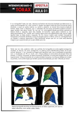 E na tomografia? Antes de tudo, devemos nos lembrar dos eixos de orientação que determinam os
cortes numa tomografia. Um corte coronal é aquele que segue o plano da sutura coronal do crânio,
dividindo o corpo em partes anterior, ou ventral e posterior, ou dorsal. Uma maneira simples de
lembrar desse corte é relacionar com a colocação de uma coroa, que lembra à palavra coronal e
segue também este plano frontal. Por sua vez, um corte sagital é aquele que divide o paciente em
laterais direita e esquerda, sejam elas metades de tamanhos iguais (plano mediano) ou não
(plano paramediano). Um macete para lembrar desse corte é que sagital lembra side, que em inglês
significa lado, os lados direito e esquerdo. Por fim, temos o plano axial, também chamado de
transversal ou horizontal, dividindo o corpo em porções superior e inferior, como se o tomógrafo fosse
um fatiador e estamos observando a fatia. Lembrando sempre que em um corte axial, devemos
imaginar que o paciente está com os pés voltado para nós.
Tendo isso em vista, podemos voltar aos pulmões. Em tomografias em cortes sagitais conseguimos
visualizar as fissuras, tal como conseguimos no perfil no raio-X, identificando os lobos. Já no corte
coronal devemos ir nos movendo na imagem para identificar tudo, mas a visualização se assemelha
com a visualização em PA no raio-X, com a fissura oblíqua no canto externo da porção inferior do
pulmão e a fissura horizontal em plano transversal. Finalmente, no corte axial conseguimos ver mais
superiormente a fissura horizontal, em um plano também transverso, e as fissuras obliquas em ambos
os pulmões, numa conformação que também parece horizontalizada, por estar “olhando por baixo”.
Nessa tomografia de tórax em laranja temos os lobos superiores, em azul os
lobos inferiores, e em verde o lobo médio.
INTENSIVO DE RAIO-X
DE
aula 01
 