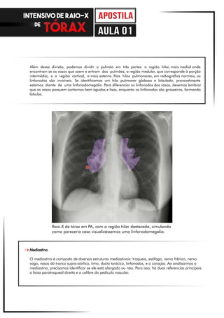Além dessa divisão, podemos dividir o pulmão em três partes: a região hilar, mais medial onde
encontram se os vasos que saem e entram dos pulmões; a região medular, que corresponde à porção
intermédia; e a região cortical, a mais externa. Nos hilos pulmonares, em radiografias normais, os
linfonodos são invisíveis. Se identificamos um hilo pulmonar globoso e lobulado, provavelmente
estamos diante de uma linfonodomegalia. Para diferenciar os linfonodos dos vasos, devemos lembrar
que os vasos possuem contornos bem agudos e lisos, enquanto os linfonodos são grosseiros, formando
lóbulos.
Mediastino
O mediastino é composto de diversas estruturas mediastinais: traqueia, esôfago, nervo frênico, nervo
vago, vasos do tronco supra-aórtico, timo, ducto torácico, linfonodos, e o coração. Ao analisarmos o
mediastino, precisamos identificar se ele está alargado ou não. Para isso, há duas referencias principais:
a faixa paratraqueal direita e o calibre do pedículo vascular.
Raio-X de tórax em PA, com a região hilar destacada, simulando
como pareceria caso visualizássemos uma linfonodomegalia.
INTENSIVO DE RAIO-X
DE
aula 01
 