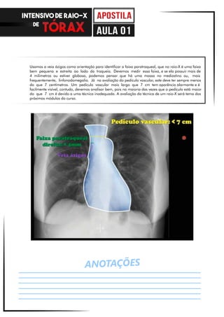 Usamos a veia ázigos como orientação para identificar a faixa paratraqueal, que no raio-X é uma faixa
bem pequena e estreita ao lado da traqueia. Devemos medir essa faixa, e se ela possuir mais de
4 milimetros ou estiver globosa, podemos pensar que há uma massa no mediastino ou, mais
frequentemente, linfonodomegalia. Já na avaliação do pedículo vascular, este deve ter sempre menos
do que 7 centímetros. Um pedículo vascular mais largo que 7 cm tem aparência alarmante e é
facilmente visível, contudo, devemos analisar bem, pois na maioria das vezes que o pedículo está maior
do que 7 cm é devido a uma técnica inadequada. A avaliação da técnica de um raio-X será tema dos
próximos módulos do curso.
ANOTAÇÕES
INTENSIVO DE RAIO-X
DE
aula 01
 