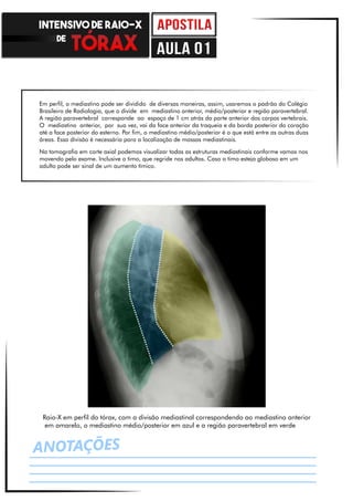 ANOTAÇÕES
Raio-X em perfil do tórax, com a divisão mediastinal correspondendo ao mediastino anterior
em amarelo, o mediastino médio/posterior em azul e a região paravertebral em verde
Em perfil, o mediastino pode ser dividido de diversas maneiras, assim, usaremos o padrão do Colégio
Brasileiro de Radiologia, que o divide em mediastino anterior, médio/posterior e região paravertebral.
A região paravertebral corresponde ao espaço de 1 cm atrás da parte anterior dos corpos vertebrais.
O mediastino anterior, por sua vez, vai da face anterior da traqueia e da borda posterior do coração
até a face posterior do esterno. Por fim, o mediastino médio/posterior é o que está entre as outras duas
áreas. Essa divisão é necessária para a localização de massas mediastinais.
Na tomografia em corte axial podemos visualizar todas as estruturas mediastinais conforme vamos nos
movendo pelo exame. Inclusive o timo, que regride nos adultos. Caso o timo esteja globoso em um
adulto pode ser sinal de um aumento tímico.
INTENSIVO DE RAIO-X
DE
aula 01
 