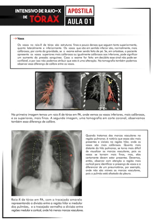 Na primeira imagem temos um raio-X de tórax em PA, onde vemos os vasos inferiores, mais calibrosos,
e os superiores, mais finos. A segunda imagem, uma tomografia em corte coronal, observamos
também essa diferença de calibre.
Raio-X de tórax em PA, com o tracejado amarelo
representando a divisão entre a região hilar e medular
dos pulmões, e o tracejado vermelho a divisão entre
regiões medular e cortical, onde há menos marcas vasculares.
Vasos
Os vasos no raio-X de tórax são estruturas finas e pouco densas que seguem tanto superiormente,
quanto lateralmente e inferiormente. Os vasos que vão em sentido inferior são, normalmente, mais
calibrosos, por conta da gravidade, se o exame estiver sendo feito de pé. Se, em ortostase, o paciente
apresenta os vasos superiores mais calibrosos ou igualmente calibrosos aos inferiores, pode significar
um aumento da pressão sanguínea. Caso o exame for feito em decúbito esse sinal não pode ser
confiável, e por isso não podemos atribuir que esta é uma alteração. Na tomografia também podemos
observar essa diferença de calibre entre os vasos.
Quando tratamos das marcas vasculares na
região pulmonar, é notório que essas são mais
presentes e visíveis na região hilar, onde os
vasos são mais calibrosos. Quanto mais
distante do hilo pulmonar, se torna mais difícil
de visualizar as marcas vasculares, pois os
vasos se tornam mais finos, mas, elas
certamente devem estar presentes. Devemos,
então, observar com atenção a região mais
cortical para identificar a presença de vasos e a
diferenciar de um pneumotórax, por exemplo,
onde não são visíveis as marcas vasculares,
pois o pulmão está afastado da pleura.
INTENSIVO DE RAIO-X
DE
aula 01
 