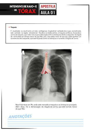 ANOTAÇÕES
Raio-X do tórax em PA, onde está marcada a traqueia e os brônquios principais.
Além disso, há a demarcação do ângulo da carina, que está normal, menor
do que 90o.
Traqueia
É visualizada no raio-X como um tubo cartilaginoso longitudinal recheado de ar que, normalmente,
está centrada na região retroesternal. Na altura no botão aórtico, a traqueia se bifurca, formando a
carina da traqueia, que nada mais é que a bifurcação entre os brônquios direito e esquerdo. O ângulo
da carina deve ser sempre menor do que 90o, pois, caso esteja maior do que isso, pode significar um
aumento do átrio esquerdo, que está forçando contra os brônquios e aumento o ângulo da carina.
INTENSIVO DE RAIO-X
DE
aula 01
 